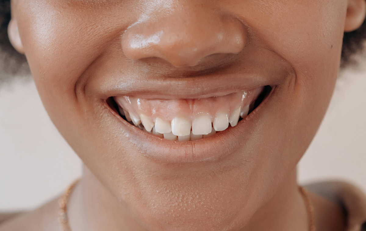 sourire_gingivale (2)