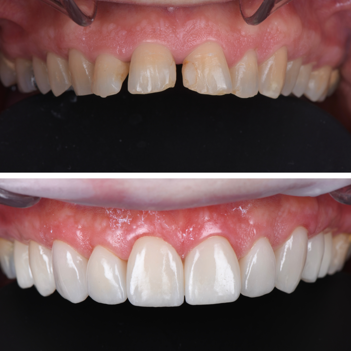 blanchiment-dentaire