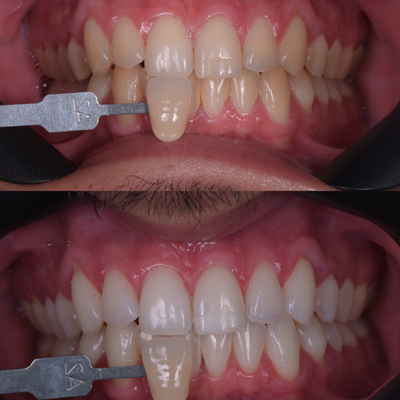 blanchiment dents facette