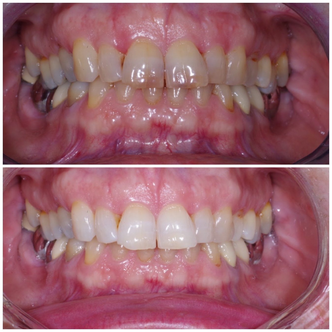 blanchiment-dents-resultat