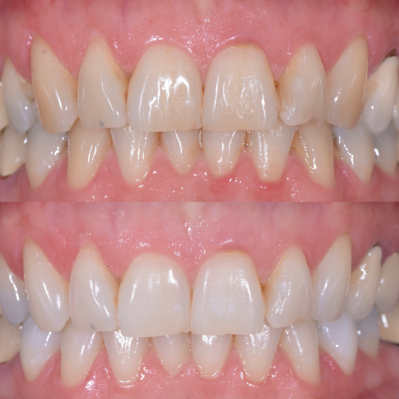 eclaircissement-dentaire-2