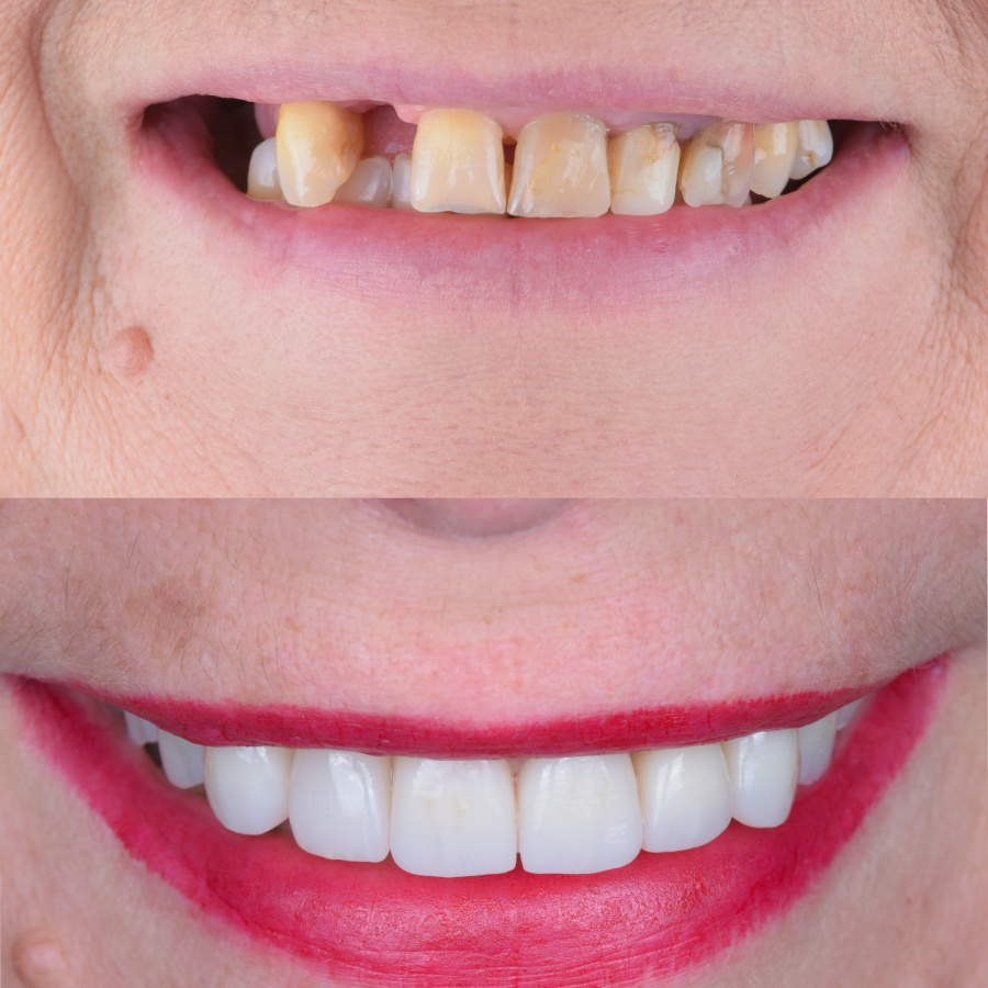 implant dentaire avant apres